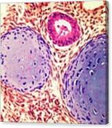 Testicular Cancer, Light Micrograph #2 Canvas Print