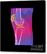 Knee Showing Osteoporosis #5 Canvas Print