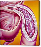 Illustration Of Crohn's Disease Of The Ileum Canvas Print