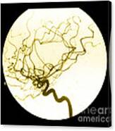 Internal Carotid Cerebral Angiogram Canvas Print