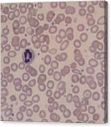 Lm Of Blood Smear Showing Iron-deficiency Anaemia Canvas Print