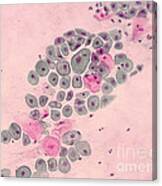 Pap Smear, Cancer Canvas Print
