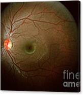 Retinal Coloboma Canvas Print