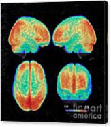 Bipolar Brain, 3d Mri Scan Canvas Print