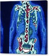 Bone Scan Showing Cancerous Lesions Canvas Print