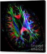 Corona Radiata, Diffuse Tensor Imaging Canvas Print