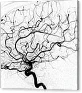 Dural Arterial Venous Fistula, Angiogram Canvas Print