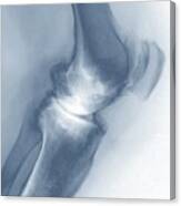 Osteoarthritis Of The Knee #15 Canvas Print