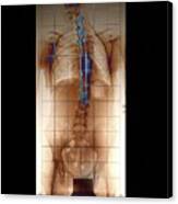 Harrington Rod Spinal Implants In Scoliosis #3 Canvas Print