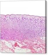 Basal Cell Carcinoma #6 Canvas Print