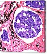 Secondary Lung Cancer, Light Micrograph Canvas Print