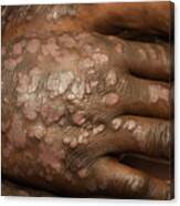 Syphilis Rash On Breast by Us National Library Of Medicine/science Photo  Library