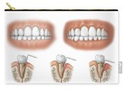 Solid-Faced Canvas Print Wall Art entitled Three stages of periodontal disease 