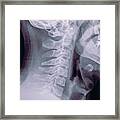 Cervical Spine X-ray #1 Framed Print