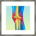 Knee Arthritis #1 Framed Print