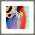 Prosthetic Hip Replacement #1 Framed Print