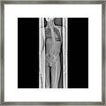 Scoliosis Of The Spine #1 Framed Print