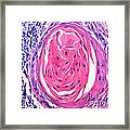 Squamous Cell Carcinoma, Keratin Pearl #2 Framed Print