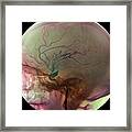 Arterial Aneurysm #2 Framed Print
