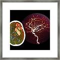 Brain Haemorrhage From Aneurysm #2 Framed Print