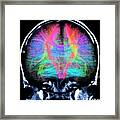 Brain Mri And White Matter Fibres Framed Print