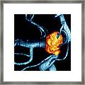 Carotid Aneurysm #4 Framed Print