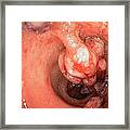 Crohn's Disease #8 Framed Print