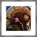 Brain Tumour Framed Print