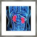 Kidney Cancer, Artwork Framed Print