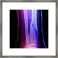 Leg Fractures With Cast Framed Print