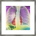 Lung Cancer, X-ray Framed Print