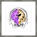 Normal  Alzheimers Brain Comparison Framed Print