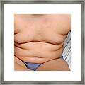 Obesity Framed Print