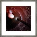 Polyp Found During A Colonoscopy Framed Print