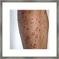 Psoriasis Skin Condition On Man's Leg Framed Print