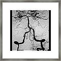 Cerebral Angiogram Framed Print
