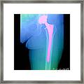 Hip Replacement #1 Framed Print