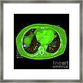 Metastatic Cancer Of The Lungs #1 Framed Print