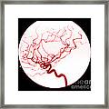 Internal Carotid Cerebral Angiogram #2 Framed Print