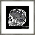 Brain Tumors #5 Framed Print