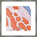 Skin Cancer, Light Micrograph #5 Framed Print