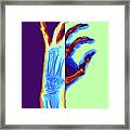 Arthritic Hand, X-ray #6 Framed Print