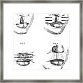 Cleft Lip Surgery, 1791 Framed Print