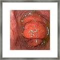 Gastro-oesophageal Prolapse Framed Print