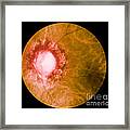 Retina Infected By Syphilis Framed Print