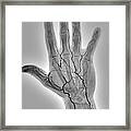 Blocked Hand Artery #1 Framed Print
