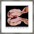 Human Small Bowel Intussusception #1 Framed Print