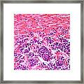 Secondary Liver Cancer, Light Micrograph #1 Framed Print