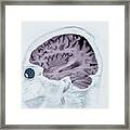 Alzheimer's Disease #19 Framed Print