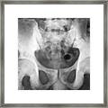Bone Metastasis Of The Pelvis Framed Print